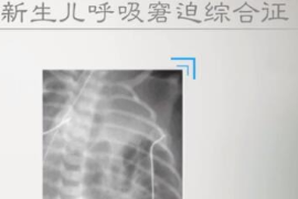 什么是新生兒呼吸窘迫綜合征？